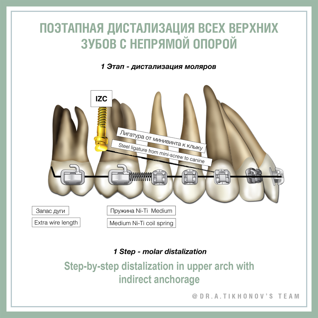 Поэтапная дистализация всех верхних зубов с непрямой опорой.