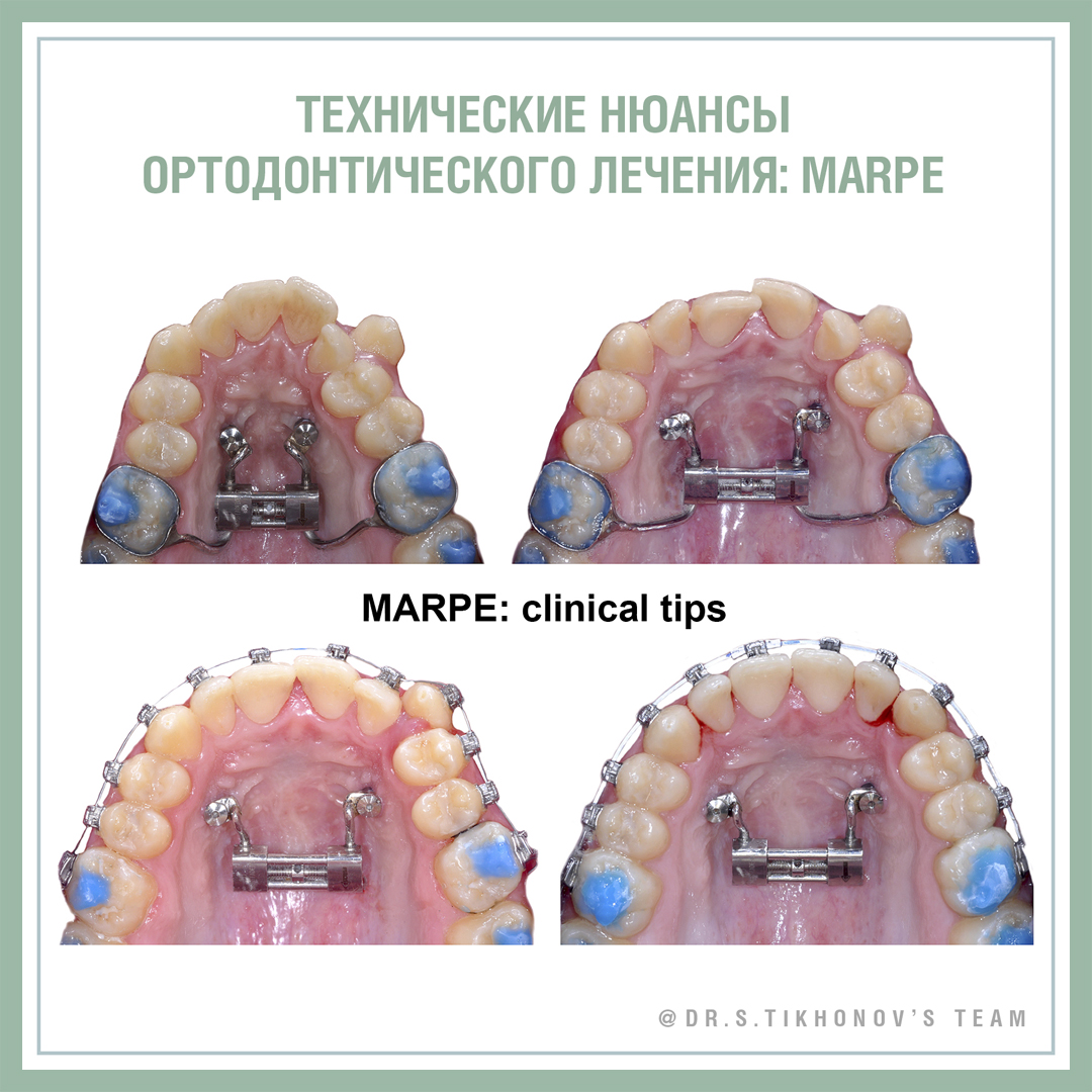 Технические нюансы ортодонтического лечения: MARPE