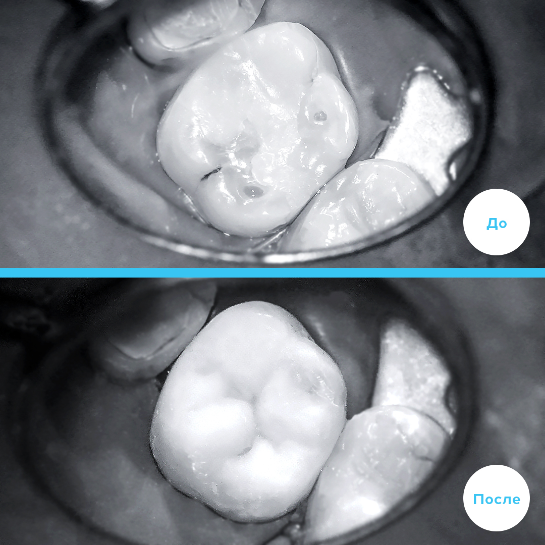ЛЕЧЕНИЕ ЗУБА ПОД МИКРОСКОПОМ