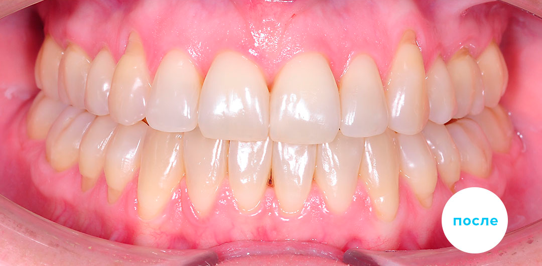 ЛЕЧЕНИЕ ПЕРЕКРЕСТНОГО ПРИКУСА, УСТРАНЕНИЕ СКУЧЕННОСТИ ЗУБОВ. 