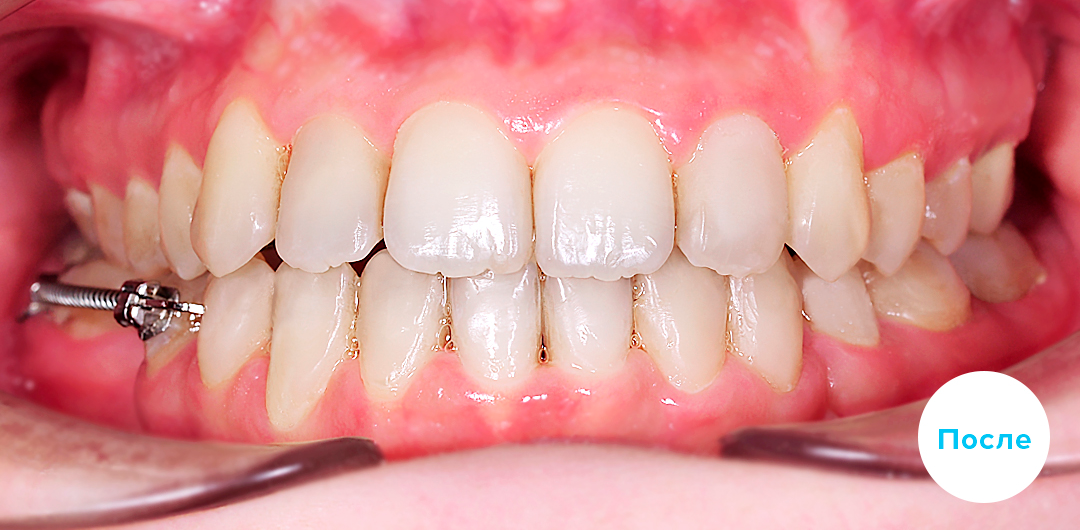 ЛЕЧЕНИЕ ПЕРЕКРЕСТНОГО ПРИКУСА, УСТРАНЕНИЕ СКУЧЕННОСТИ ЗУБОВ. 