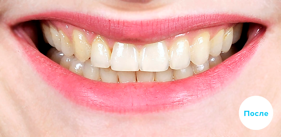 ЛЕЧЕНИЕ ПЕРЕКРЕСТНОГО ПРИКУСА, УСТРАНЕНИЕ СКУЧЕННОСТИ ЗУБОВ. 