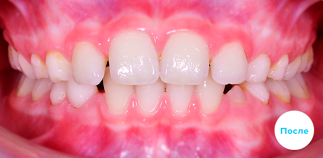 ЛЕЧЕНИЕ ПЕРЕКРЕСТНОГО ПРИКУСА, УСТРАНЕНИЕ СКУЧЕННОСТИ ЗУБОВ. 