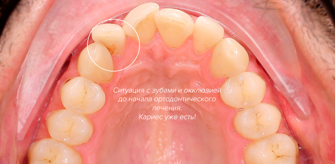 ЛЕЧЕНИЕ ПЕРЕКРЕСТНОГО ПРИКУСА, УСТРАНЕНИЕ СКУЧЕННОСТИ ЗУБОВ. 