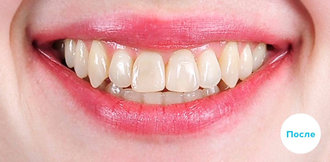 ЛЕЧЕНИЕ ПЕРЕКРЕСТНОГО ПРИКУСА, УСТРАНЕНИЕ СКУЧЕННОСТИ ЗУБОВ. 