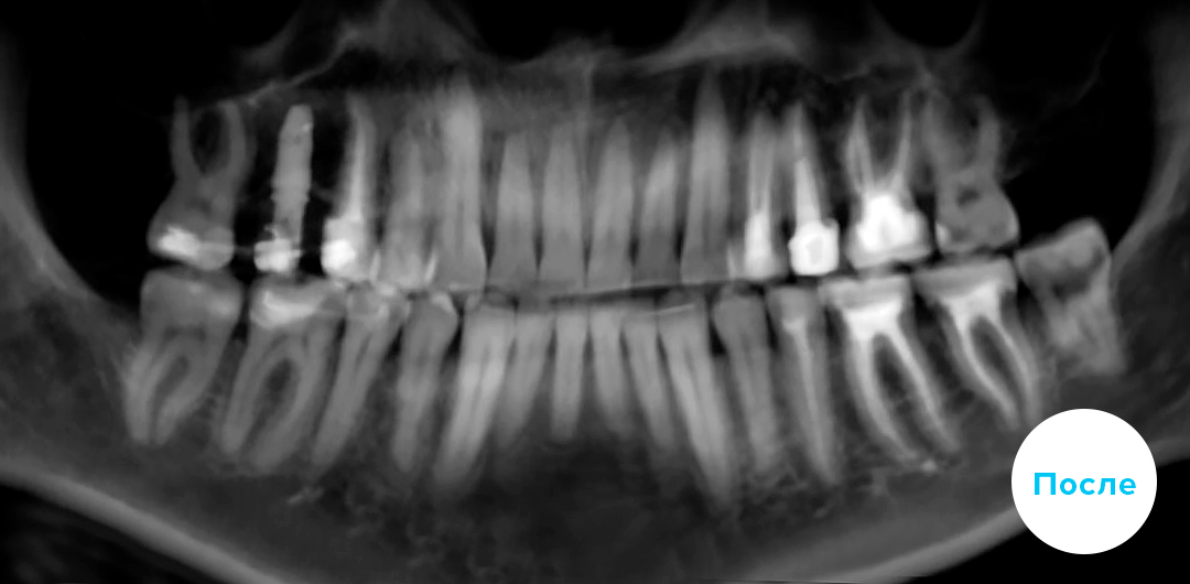 ЛЕЧЕНИЕ ПЕРЕКРЕСТНОГО ПРИКУСА, УСТРАНЕНИЕ СКУЧЕННОСТИ ЗУБОВ. 
