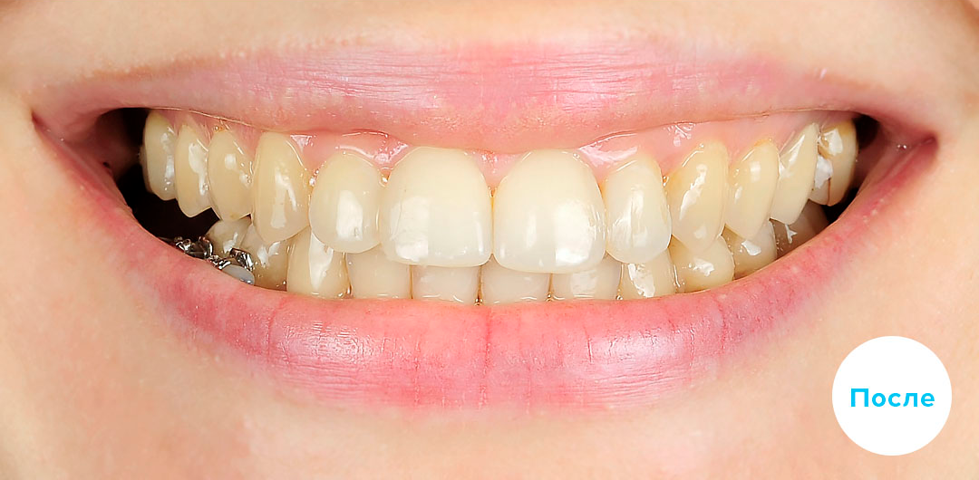 ЛЕЧЕНИЕ ПЕРЕКРЕСТНОГО ПРИКУСА, УСТРАНЕНИЕ СКУЧЕННОСТИ ЗУБОВ. 