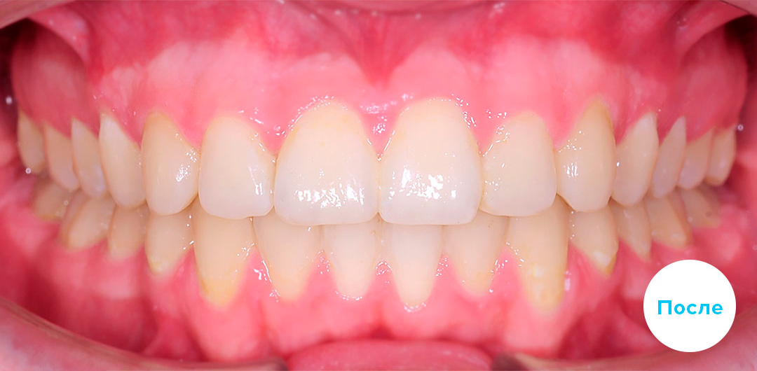 ЛЕЧЕНИЕ ПЕРЕКРЕСТНОГО ПРИКУСА, УСТРАНЕНИЕ СКУЧЕННОСТИ ЗУБОВ. 