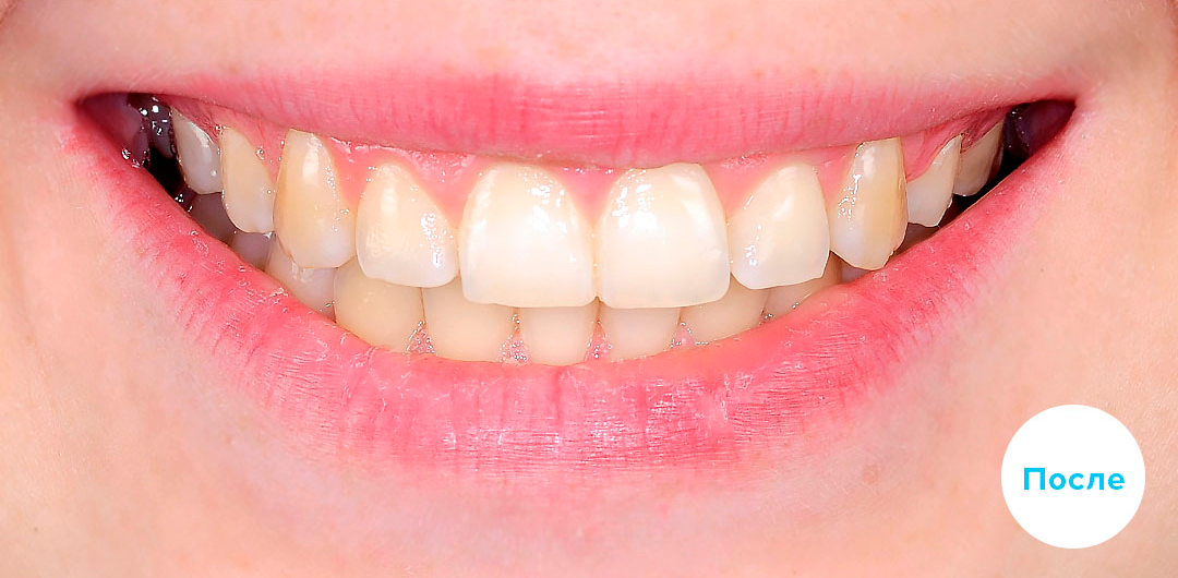 ЛЕЧЕНИЕ ПЕРЕКРЕСТНОГО ПРИКУСА, УСТРАНЕНИЕ СКУЧЕННОСТИ ЗУБОВ. 