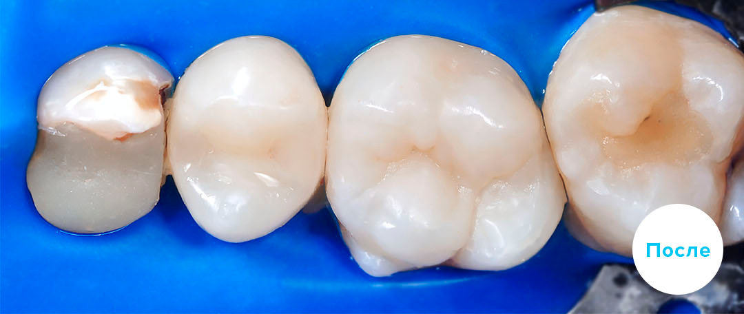 ЛЕЧЕНИЕ ПЕРЕКРЕСТНОГО ПРИКУСА, УСТРАНЕНИЕ СКУЧЕННОСТИ ЗУБОВ.