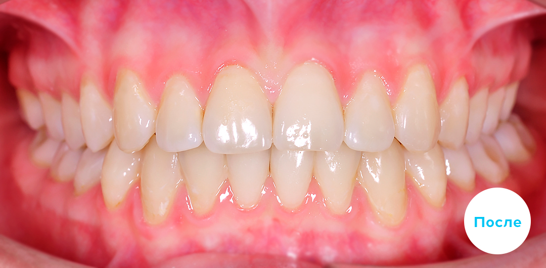 ЛЕЧЕНИЕ ПЕРЕКРЕСТНОГО ПРИКУСА, УСТРАНЕНИЕ СКУЧЕННОСТИ ЗУБОВ. 