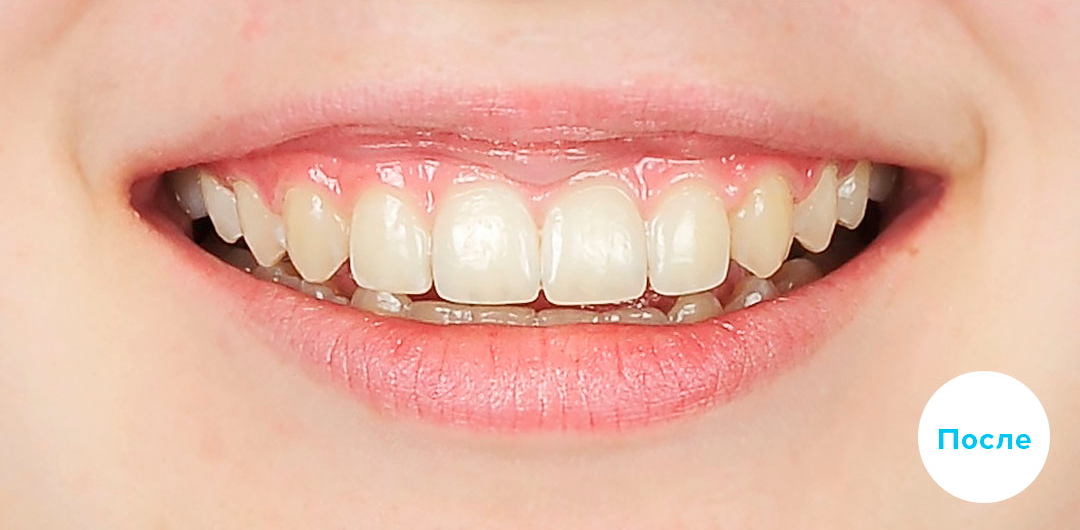 ЛЕЧЕНИЕ ПЕРЕКРЕСТНОГО ПРИКУСА, УСТРАНЕНИЕ СКУЧЕННОСТИ ЗУБОВ. 