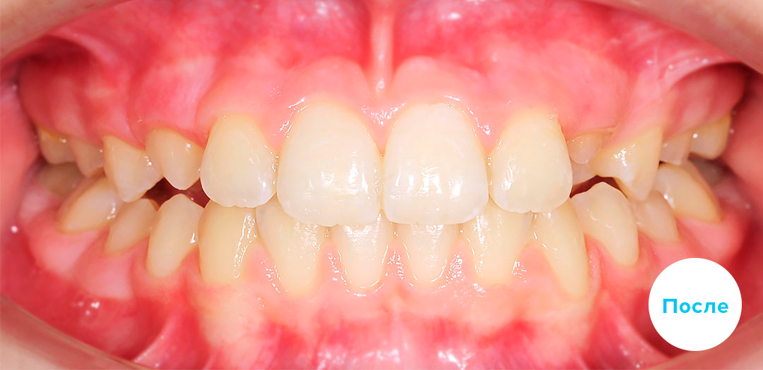 ЛЕЧЕНИЕ ПЕРЕКРЕСТНОГО ПРИКУСА, УСТРАНЕНИЕ СКУЧЕННОСТИ ЗУБОВ. 