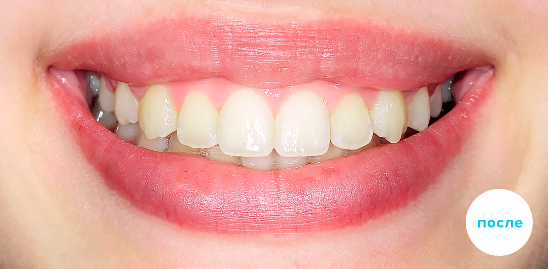 ЛЕЧЕНИЕ ПЕРЕКРЕСТНОГО ПРИКУСА, УСТРАНЕНИЕ СКУЧЕННОСТИ ЗУБОВ. 