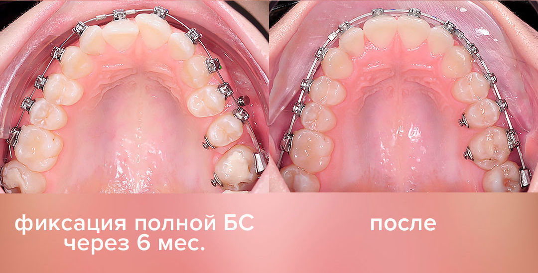 ЛЕЧЕНИЕ ПЕРЕКРЕСТНОГО ПРИКУСА, УСТРАНЕНИЕ СКУЧЕННОСТИ ЗУБОВ. 