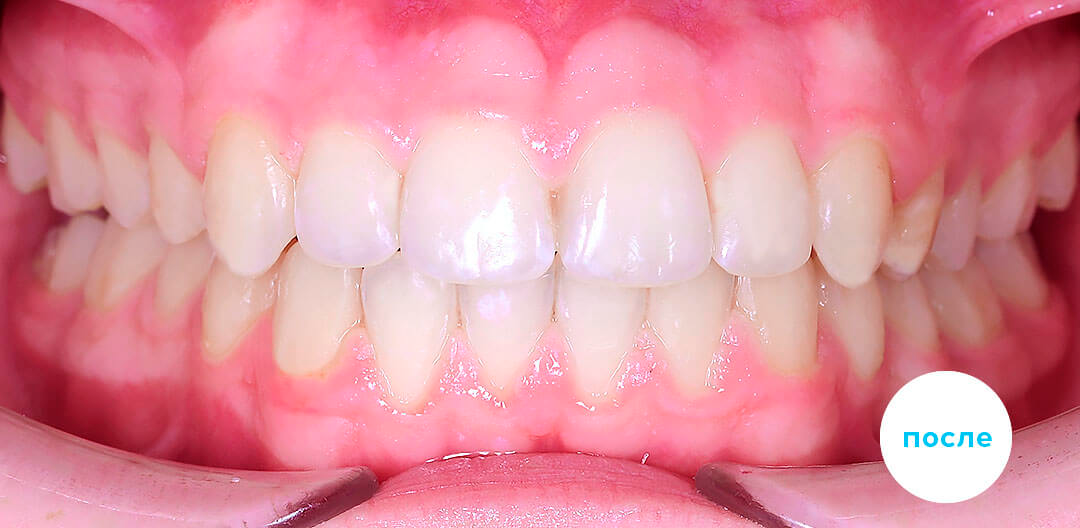 ЛЕЧЕНИЕ ПЕРЕКРЕСТНОГО ПРИКУСА, УСТРАНЕНИЕ СКУЧЕННОСТИ ЗУБОВ. 