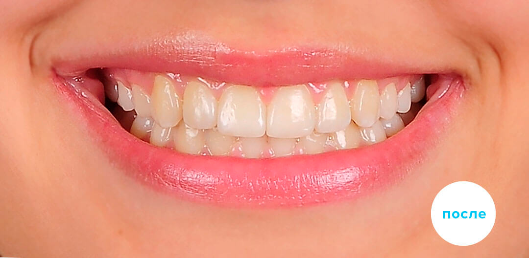 ЛЕЧЕНИЕ ПЕРЕКРЕСТНОГО ПРИКУСА, УСТРАНЕНИЕ СКУЧЕННОСТИ ЗУБОВ. 