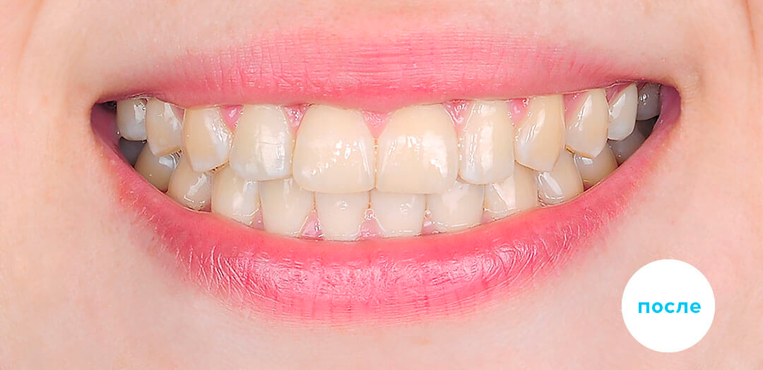 ЛЕЧЕНИЕ ПЕРЕКРЕСТНОГО ПРИКУСА, УСТРАНЕНИЕ СКУЧЕННОСТИ ЗУБОВ. 