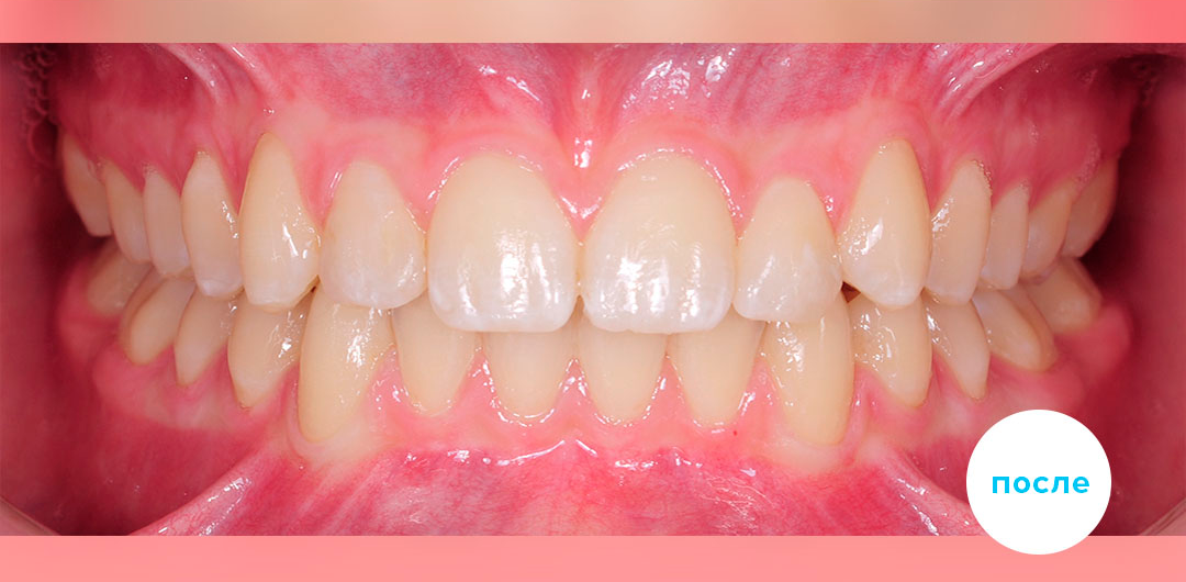 ЛЕЧЕНИЕ ПЕРЕКРЕСТНОГО ПРИКУСА, УСТРАНЕНИЕ СКУЧЕННОСТИ ЗУБОВ. 