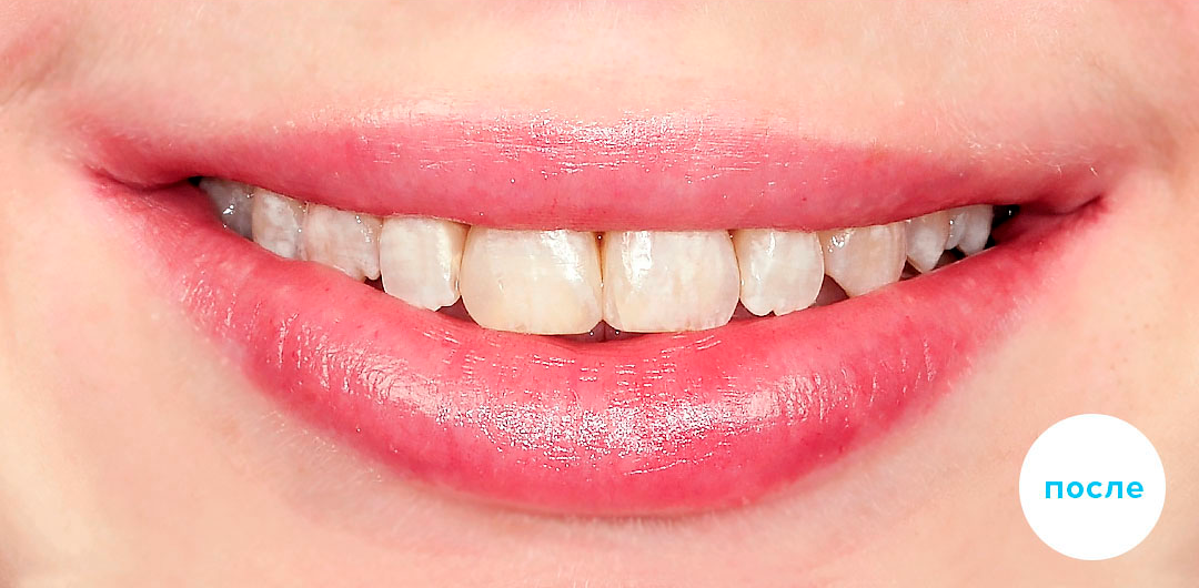 ЛЕЧЕНИЕ ПЕРЕКРЕСТНОГО ПРИКУСА, УСТРАНЕНИЕ СКУЧЕННОСТИ ЗУБОВ. 