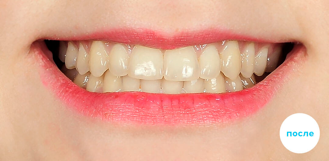 ЛЕЧЕНИЕ ПЕРЕКРЕСТНОГО ПРИКУСА, УСТРАНЕНИЕ СКУЧЕННОСТИ ЗУБОВ. 