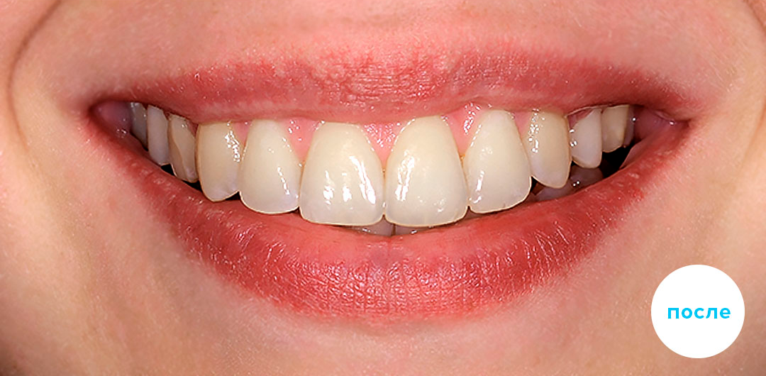 ЛЕЧЕНИЕ ПЕРЕКРЕСТНОГО ПРИКУСА, УСТРАНЕНИЕ СКУЧЕННОСТИ ЗУБОВ. 