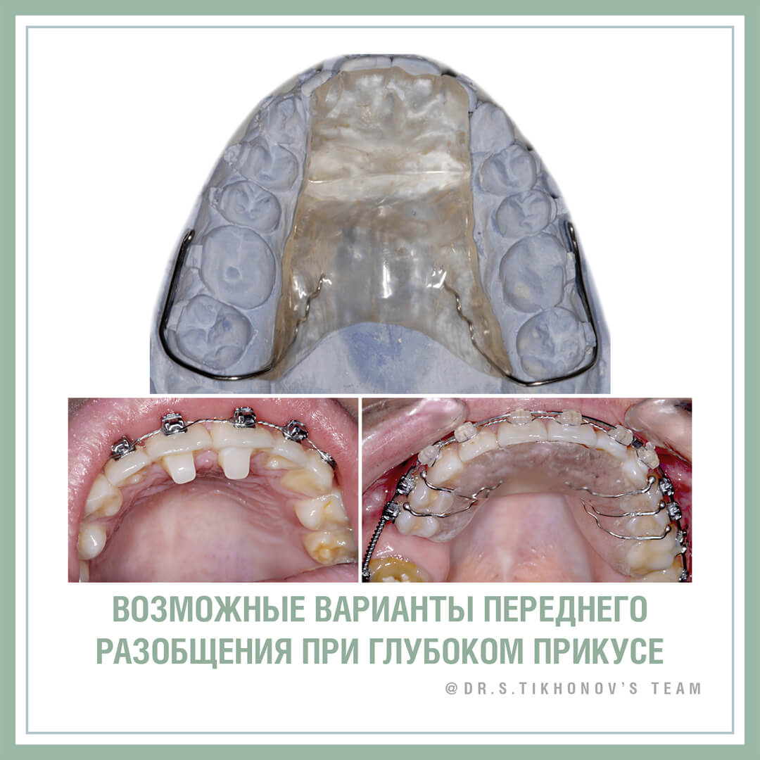 Возможные варианты переднего разобщения при переднем прикусе