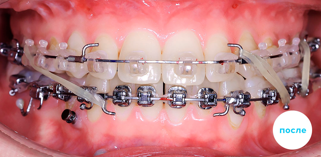 ЛЕЧЕНИЕ ПЕРЕКРЕСТНОГО ПРИКУСА, УСТРАНЕНИЕ СКУЧЕННОСТИ ЗУБОВ. 