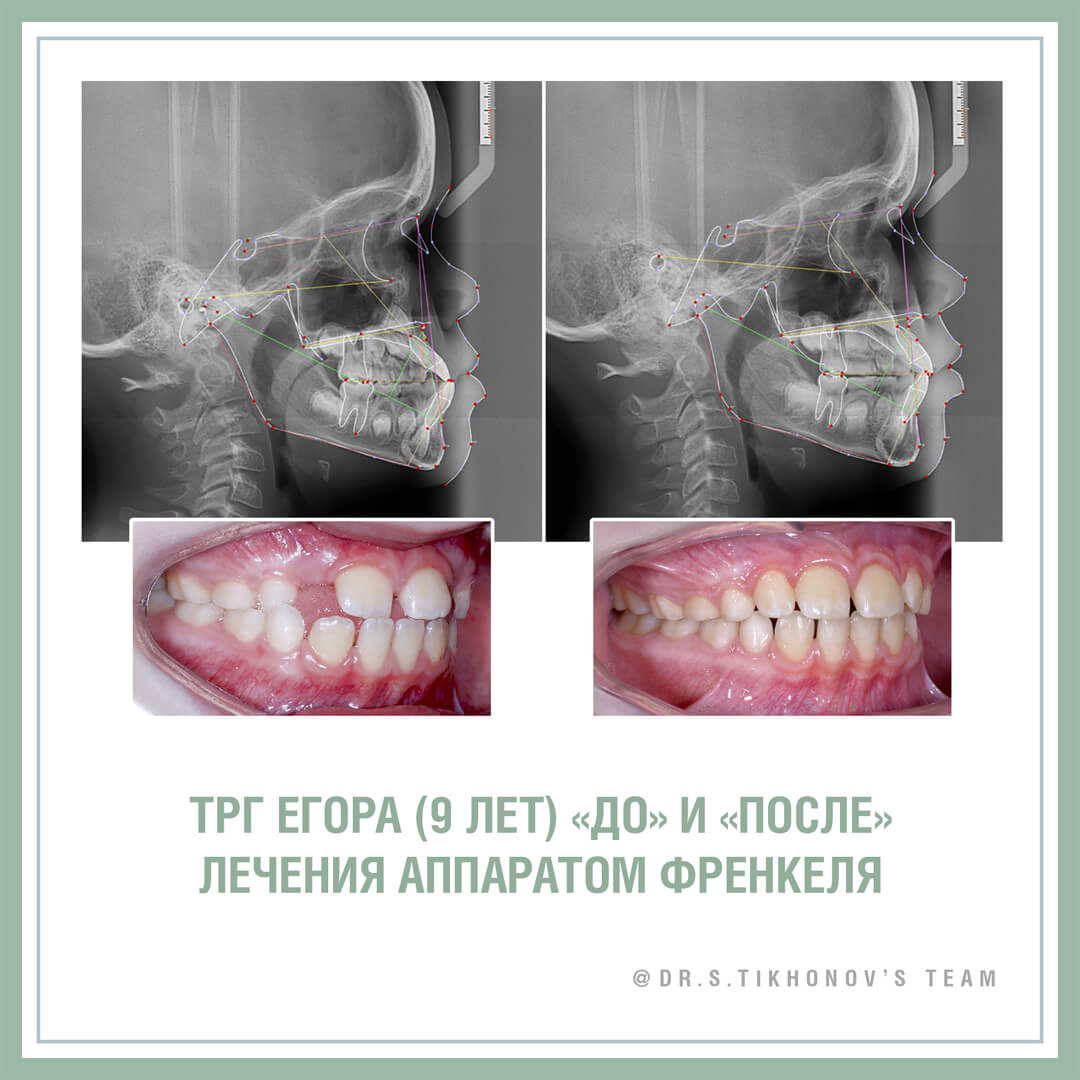 ТРГ Егора (9 лет) «до» и «после» лечения аппаратом Френкеля