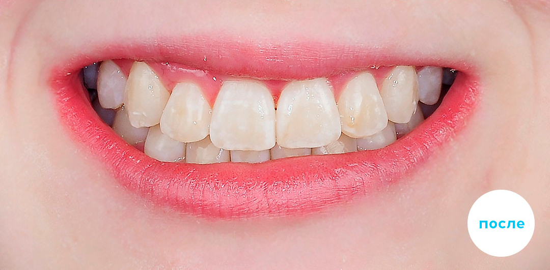 ЛЕЧЕНИЕ ПЕРЕКРЕСТНОГО ПРИКУСА, УСТРАНЕНИЕ СКУЧЕННОСТИ ЗУБОВ. 