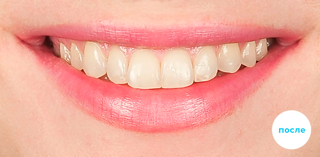 ЛЕЧЕНИЕ ПЕРЕКРЕСТНОГО ПРИКУСА, УСТРАНЕНИЕ СКУЧЕННОСТИ ЗУБОВ. 