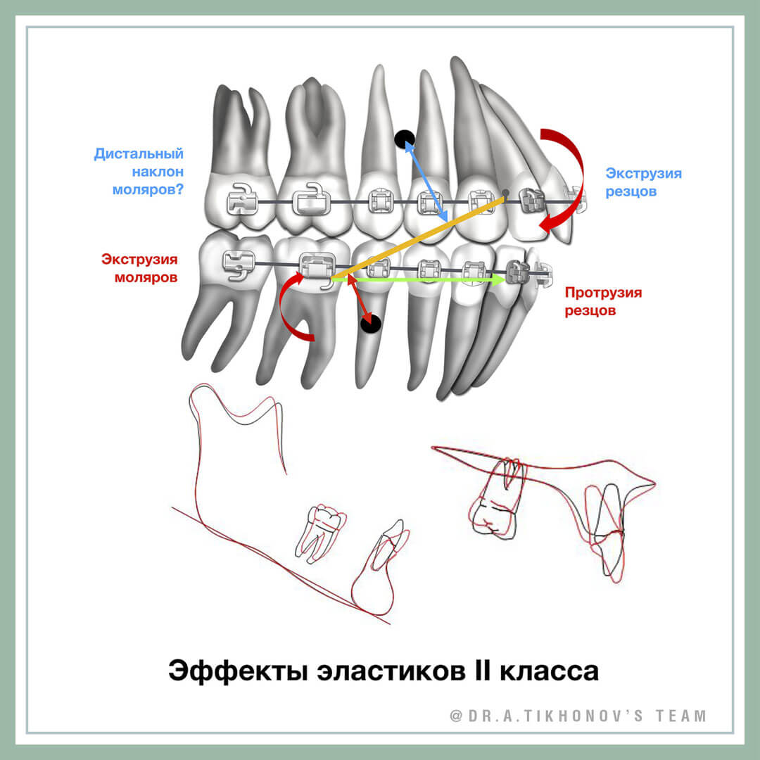 Эффекты эластиков 2 класса