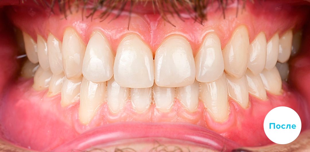 ЛЕЧЕНИЕ ПЕРЕКРЕСТНОГО ПРИКУСА, УСТРАНЕНИЕ СКУЧЕННОСТИ ЗУБОВ. 