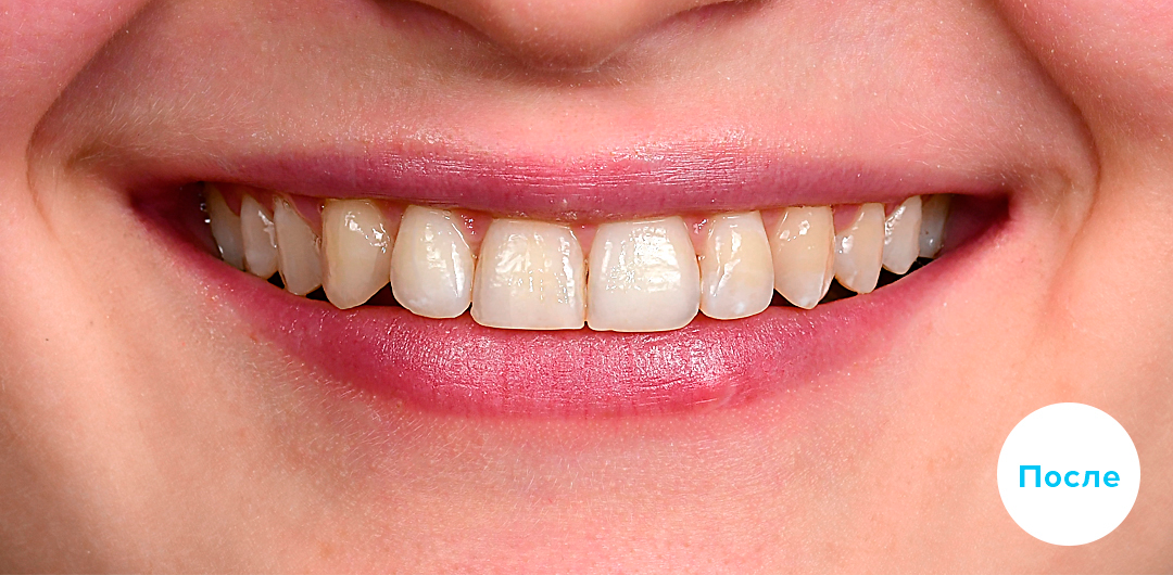 ЛЕЧЕНИЕ ПЕРЕКРЕСТНОГО ПРИКУСА, УСТРАНЕНИЕ СКУЧЕННОСТИ ЗУБОВ. 