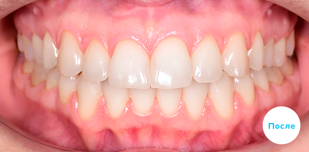 ЛЕЧЕНИЕ ПЕРЕКРЕСТНОГО ПРИКУСА, УСТРАНЕНИЕ СКУЧЕННОСТИ ЗУБОВ. 