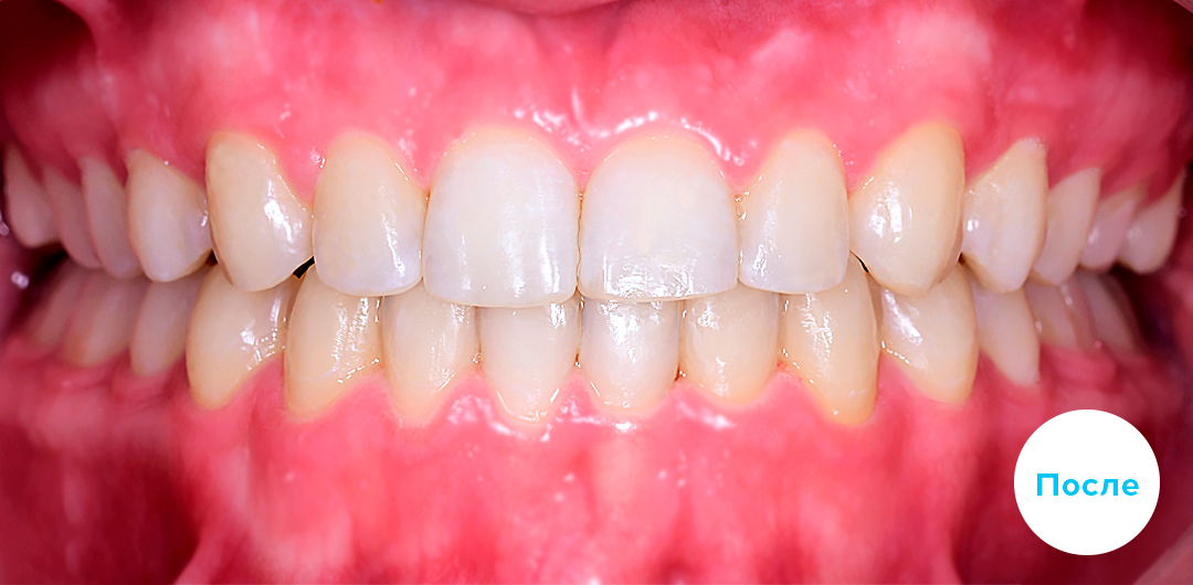 ЛЕЧЕНИЕ ПЕРЕКРЕСТНОГО ПРИКУСА, УСТРАНЕНИЕ СКУЧЕННОСТИ ЗУБОВ. 