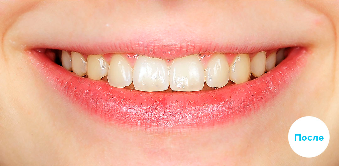 ЛЕЧЕНИЕ ПЕРЕКРЕСТНОГО ПРИКУСА, УСТРАНЕНИЕ СКУЧЕННОСТИ ЗУБОВ. 