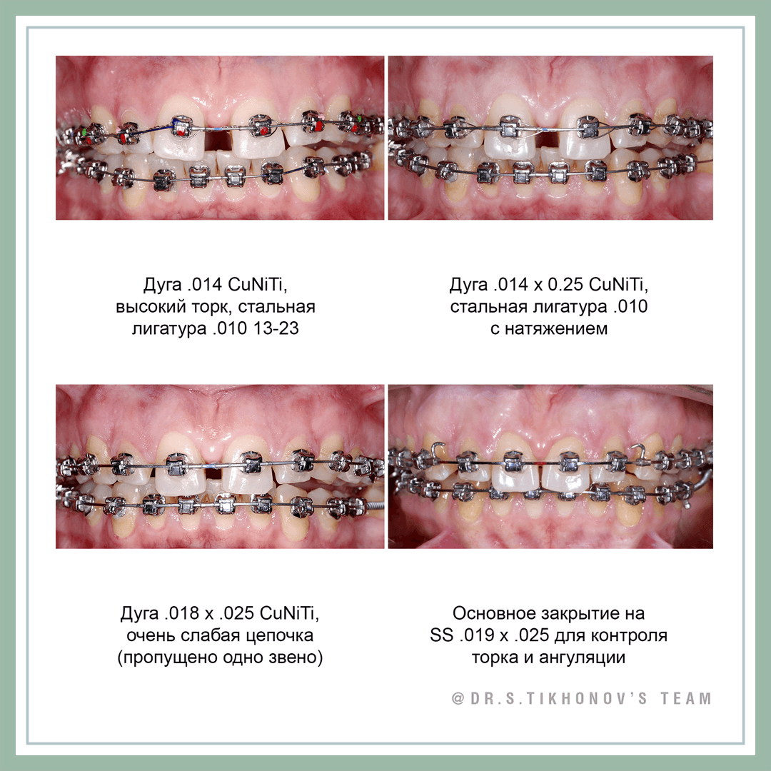 10 советов по закрытию большой диастемы от Сергея Тихонова