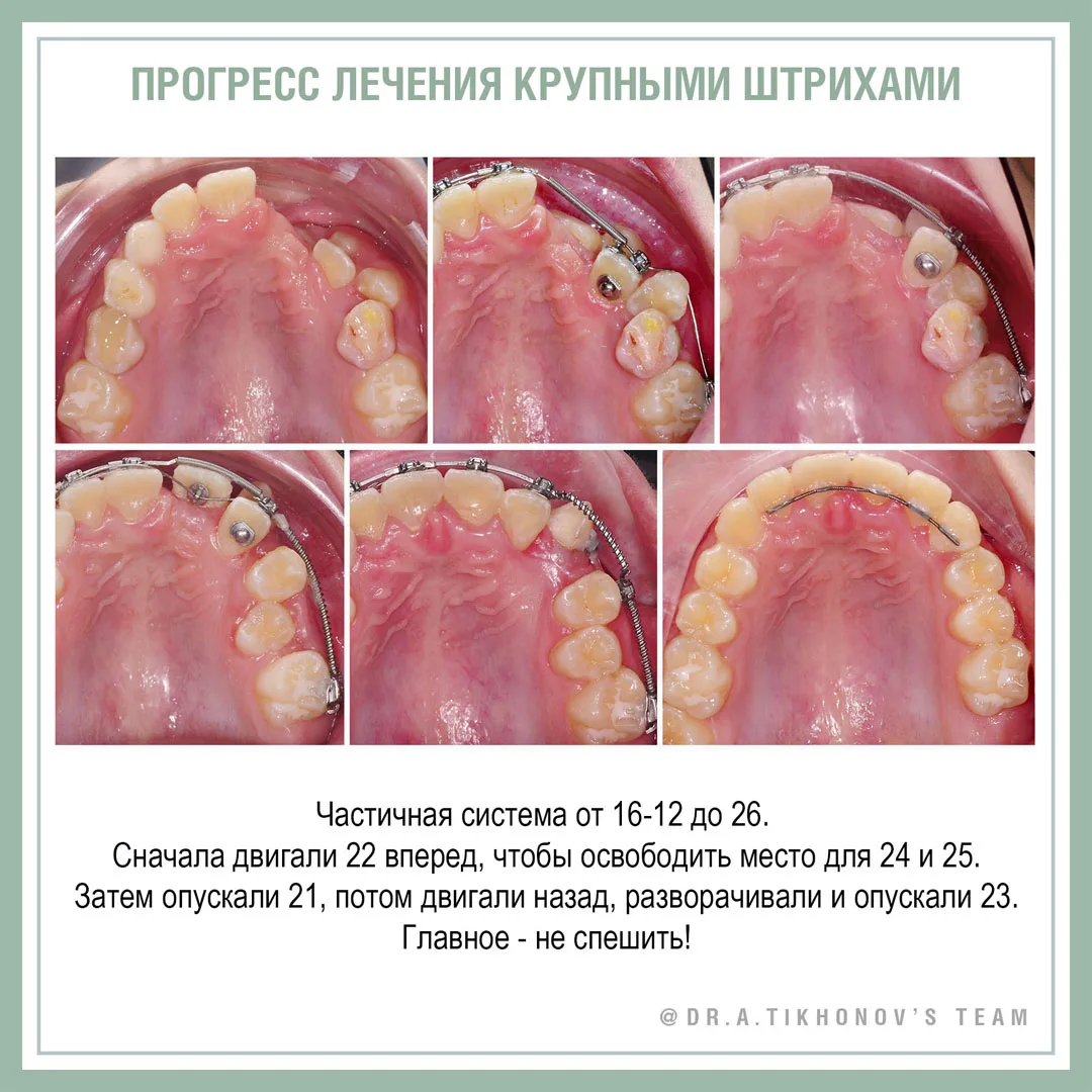 Ретенция и частичная транспозиция