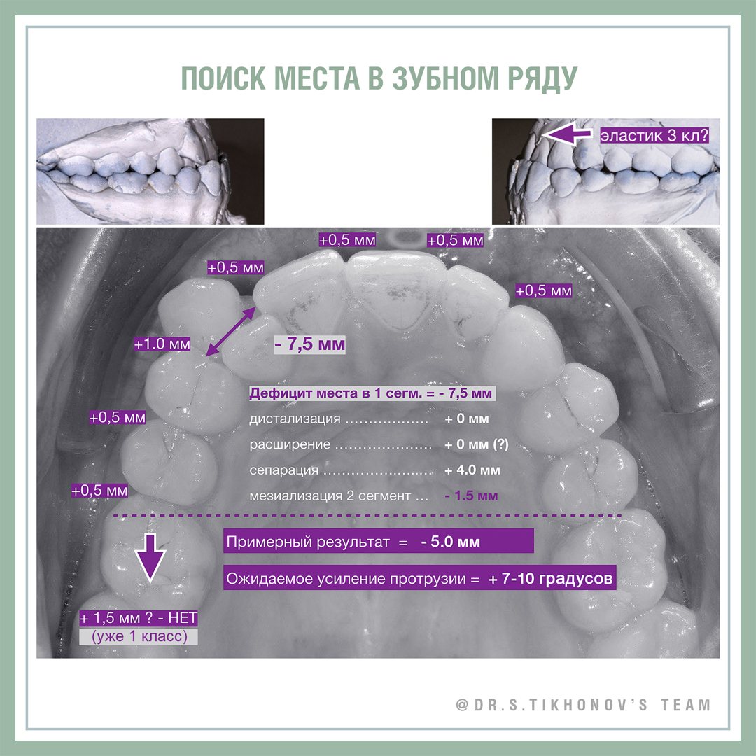 Поиск места в зубном ряду