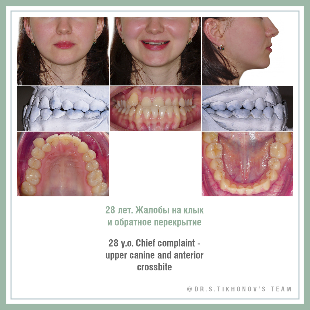 28 лет. Жалобы на клык и обратное перекрытие
