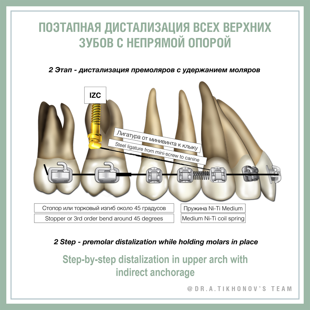 Поэтапная дистализация всех верхних зубов с непрямой опорой. 2 этап - дистализация премоляров с удержанием моляров