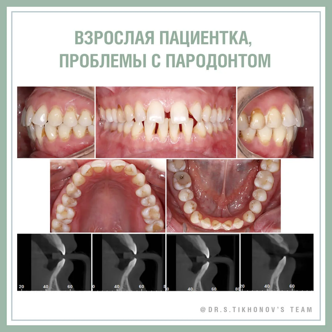 Взрослая пациентка, проблемы с пародонтом