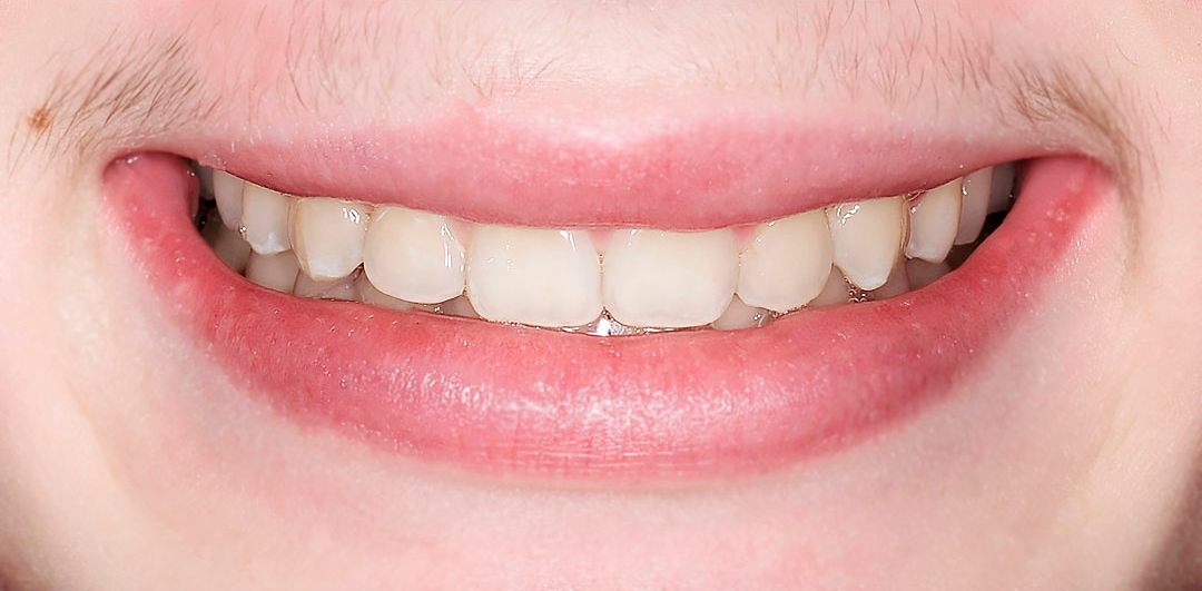 ЛЕЧЕНИЕ ПЕРЕКРЕСТНОГО ПРИКУСА, УСТРАНЕНИЕ СКУЧЕННОСТИ ЗУБОВ. 