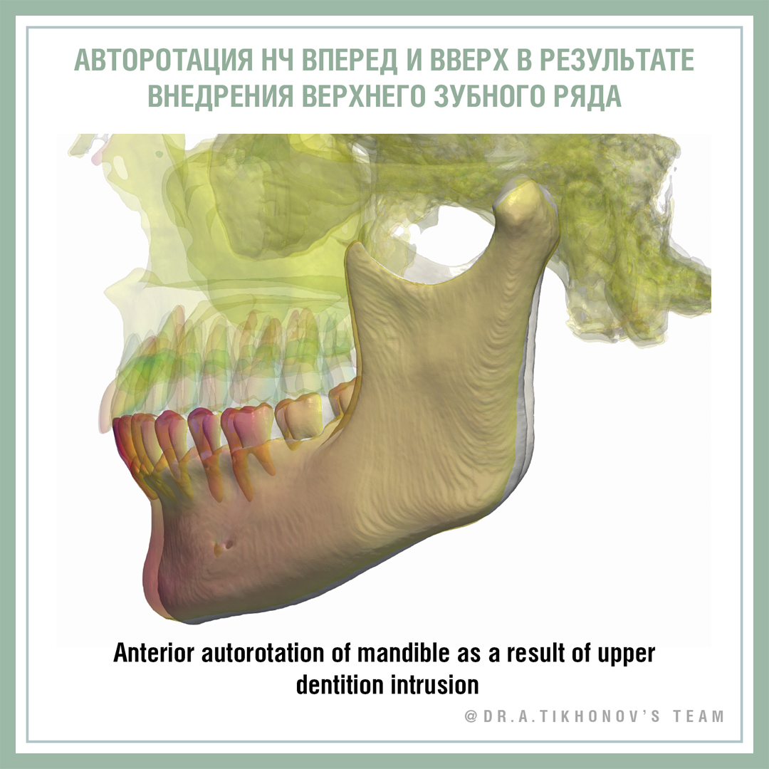Авторотация НЧ вперед и вверх в результате внедрения верхнего зубного ряда