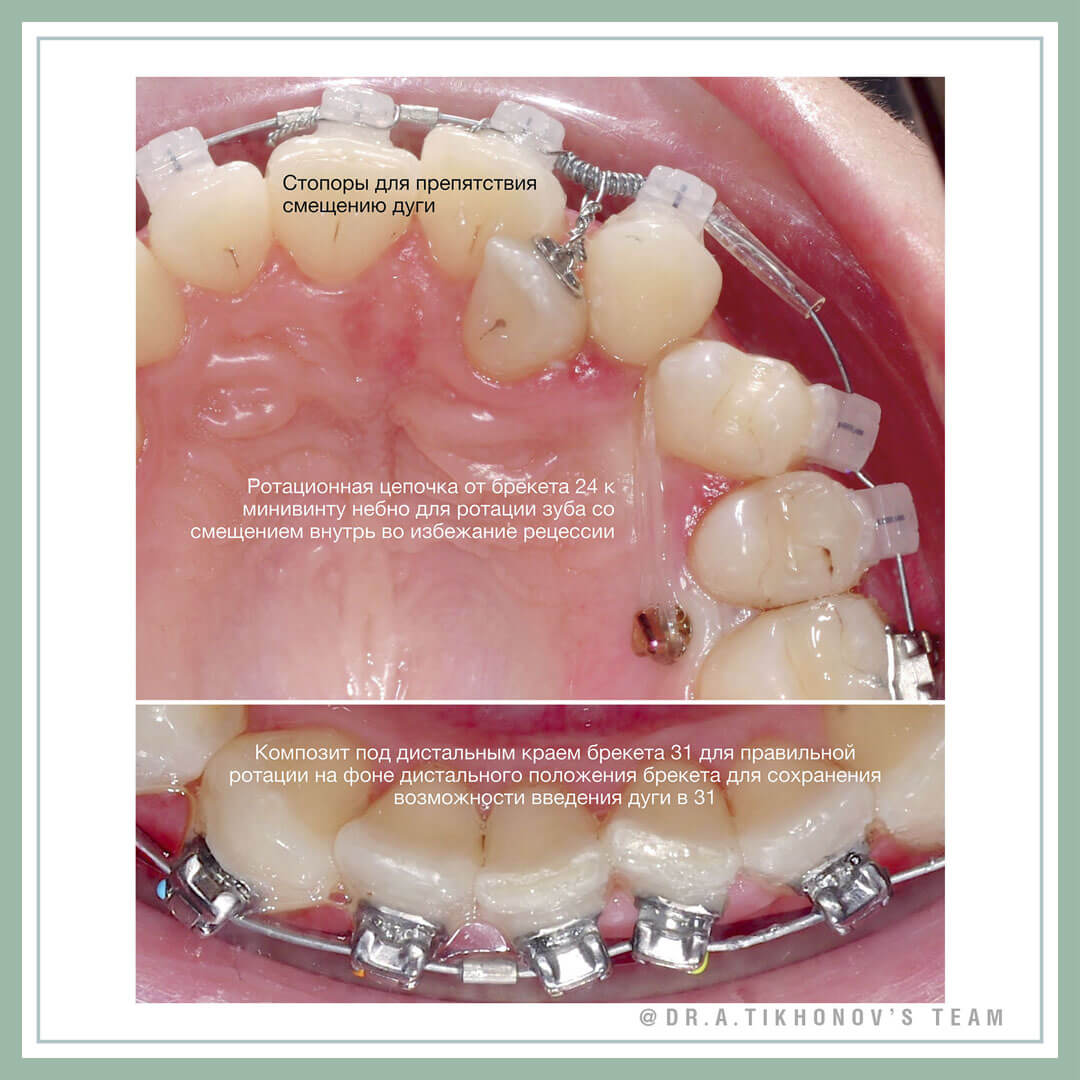 Технические нюансы ортодонтического лечения