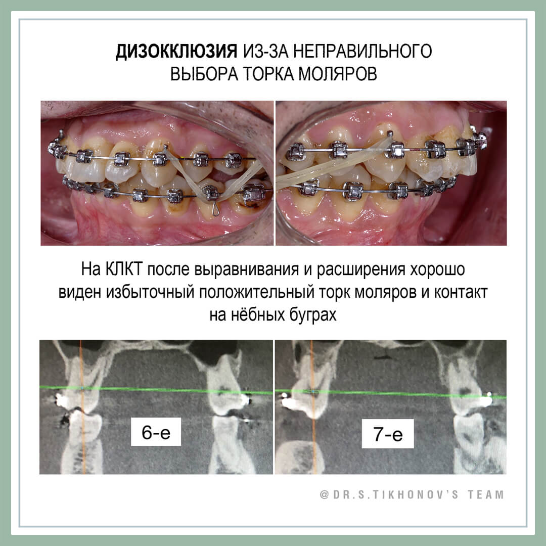 Дизокклюзия из-за неправильного выбора торка моляров