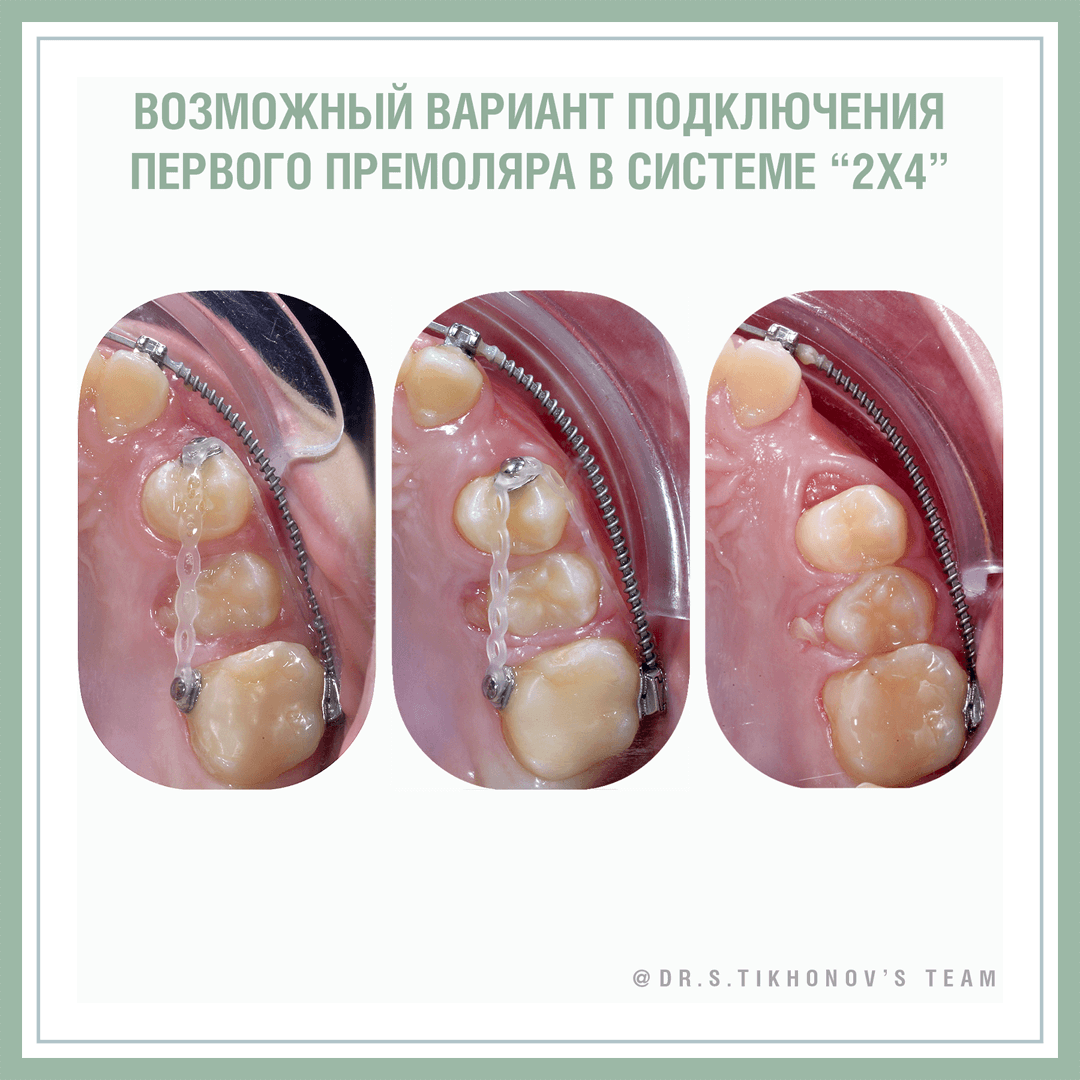 Непослушная 4-ка, или нюансы лечение частичной брекет-системой