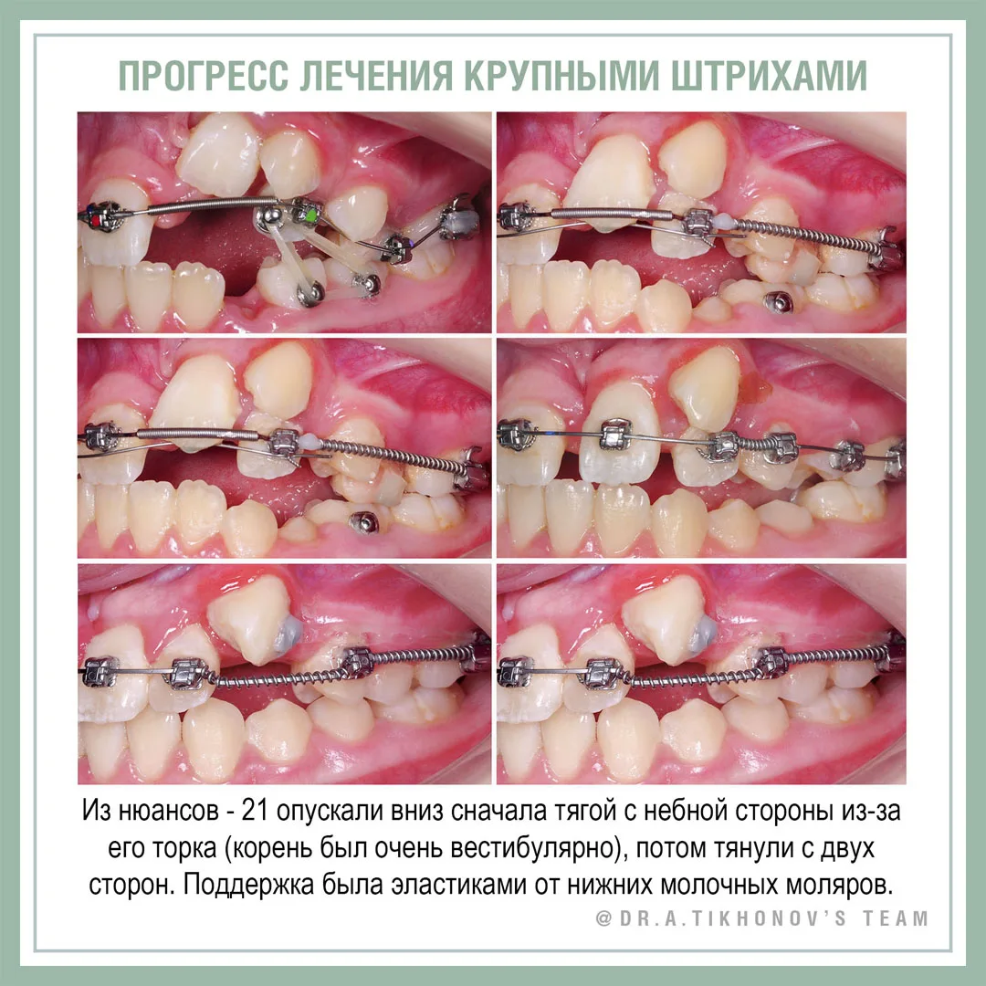 Прогресс лечения крупными штрихами