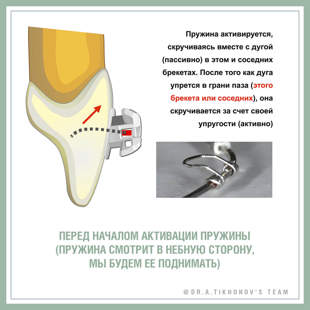 Перед началом активации пружины (пружина смотрит в небную сторону, мы будем ее поднимать)